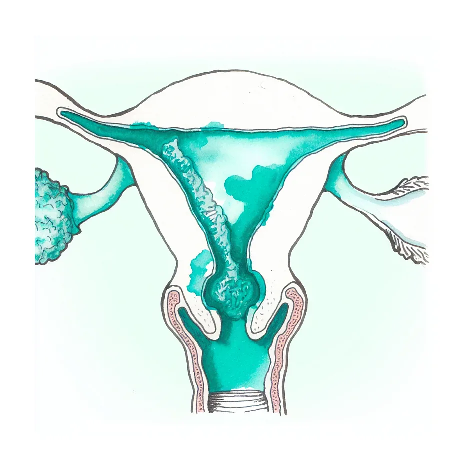 خطرات Chronic cervicitis در کلوپسکوپی