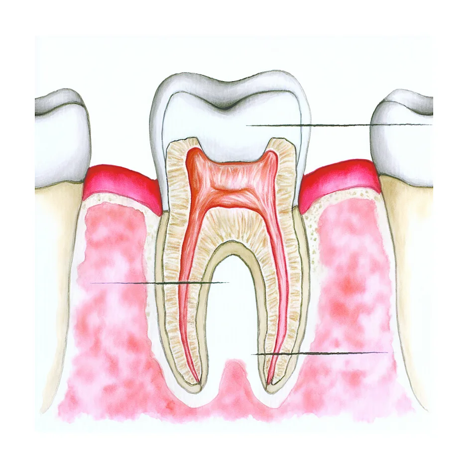 تراش دندان برای روکش: طبیعی است یا مشکل؟