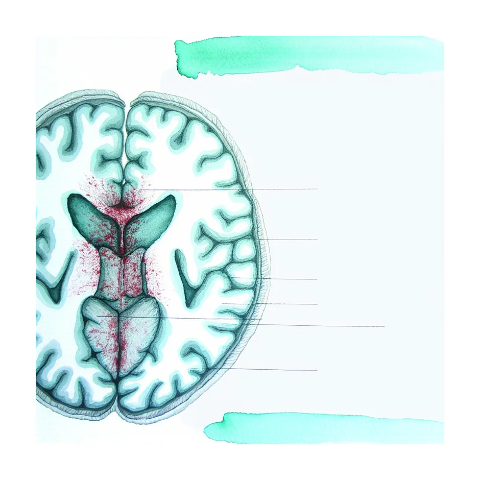 سردرد شدید بعد از آنژیوگرافی: آیا MRI مغزی لازم است؟