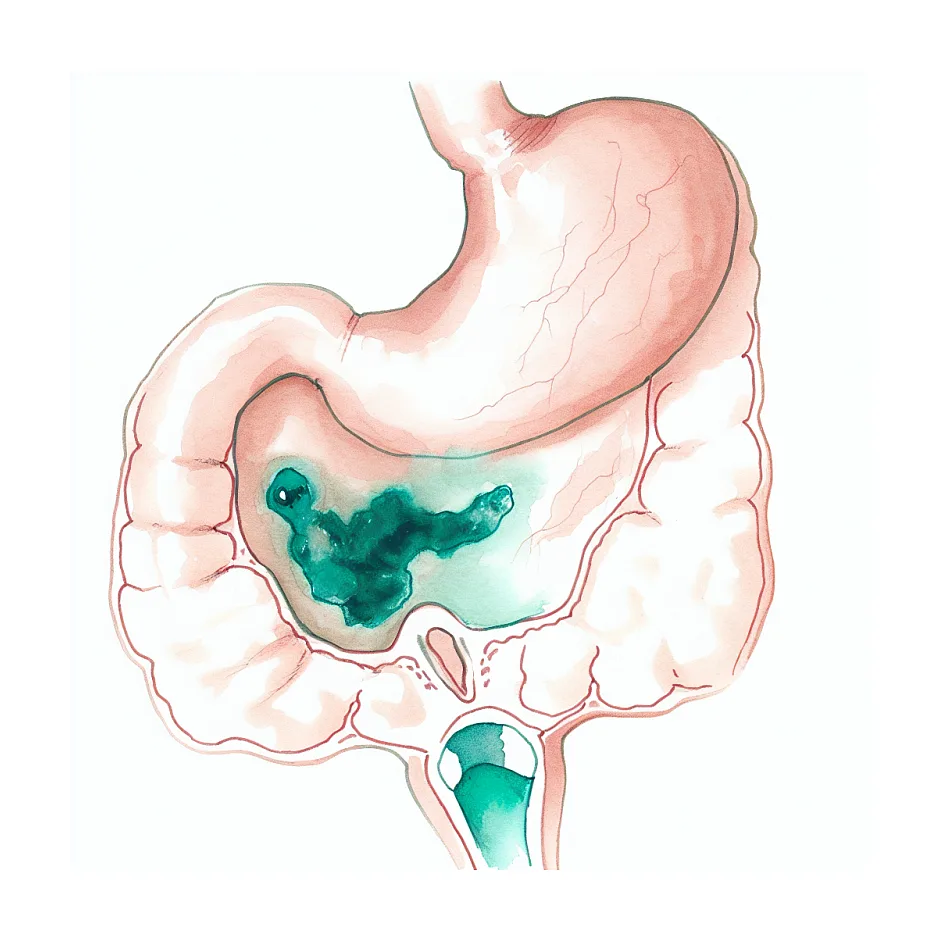 توده سمت راست پایین شکم — علت محتمل و چه کنید