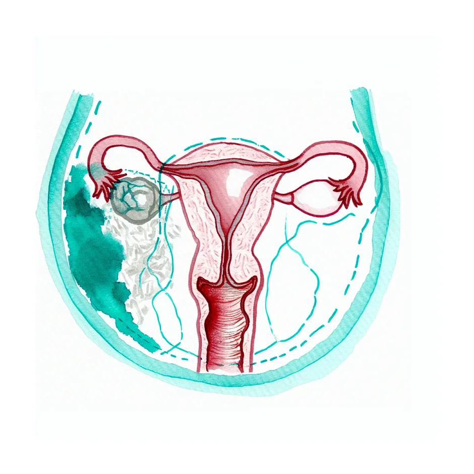 آیا به دلیل استفاده از توالت ایرانی بخیه عمل فیبروم باز می‌شود؟