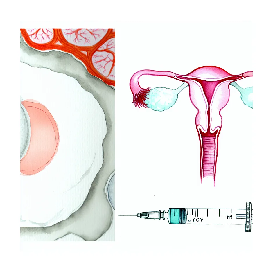 آیا آمپول HCG پیش از انجام IUI بعد از 60 ساعت همچنان اثربخش است؟