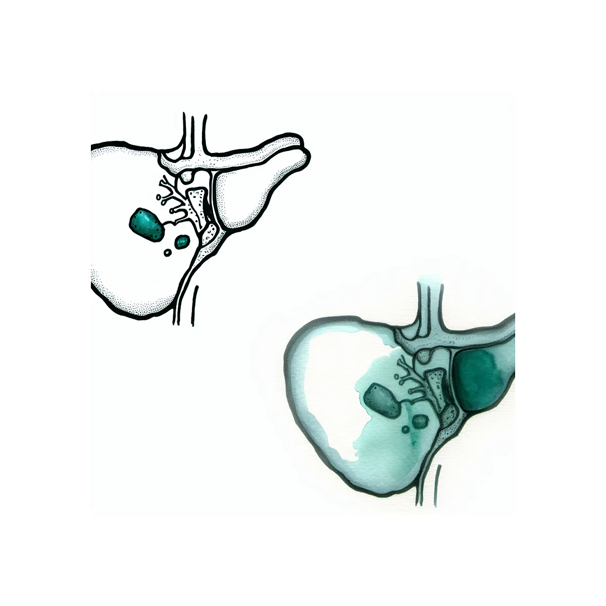 روزه گرفتن با سنگ کیسه صفرا؛ مضر است یا مجاز؟