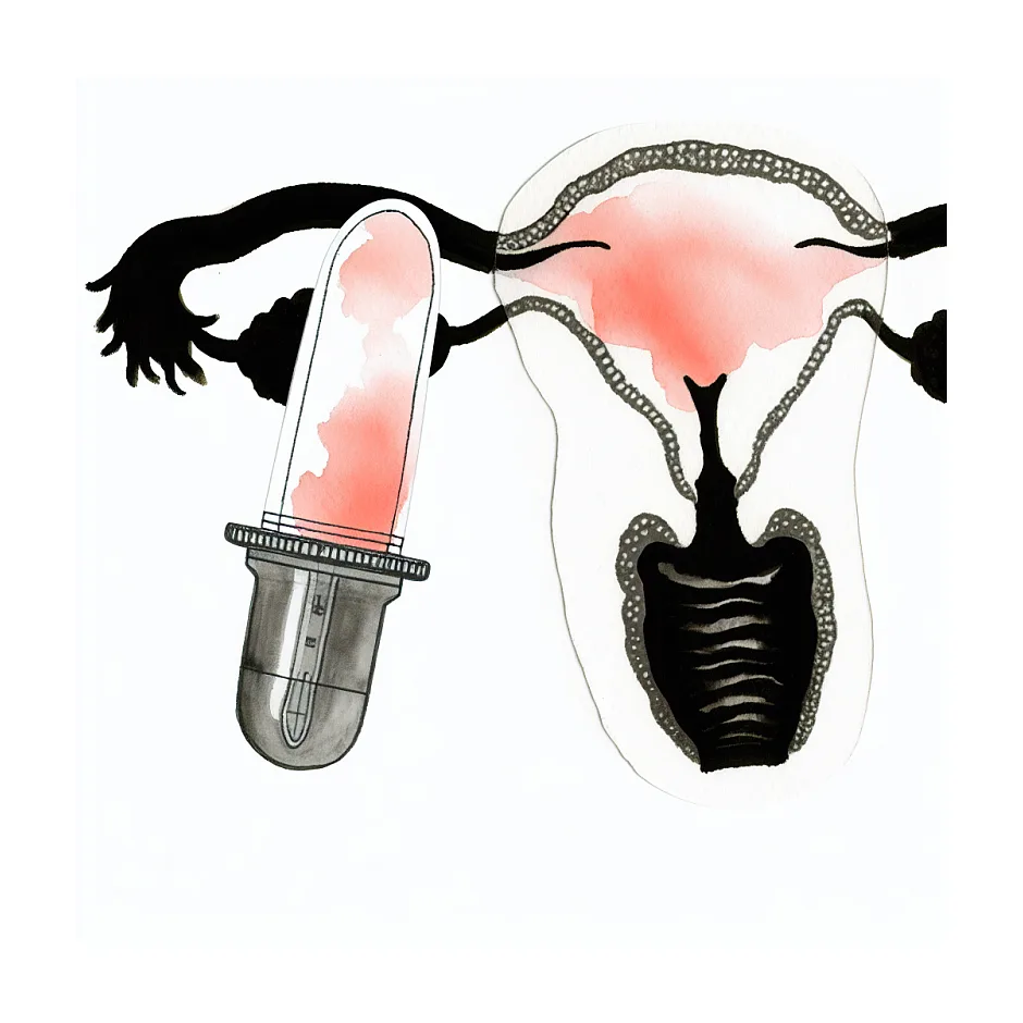استفاده از شیاف پروژسترون: آیا ضروری است در بارداری پوچ؟